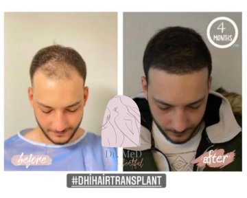 FUE hair transplant All Included - photo 2
