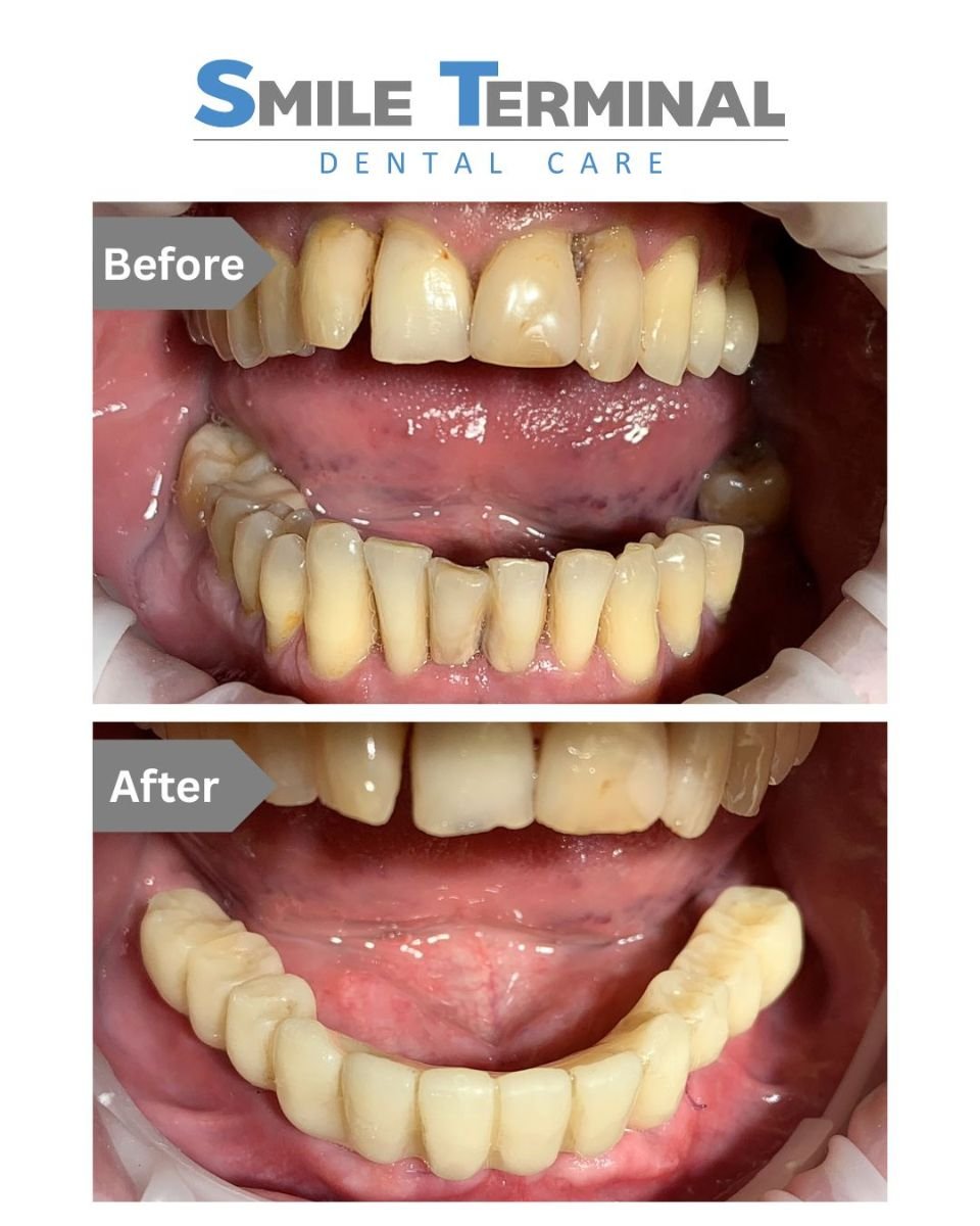 Before and after dental implant results at Smile Terminal Dental Care, restored lower teeth