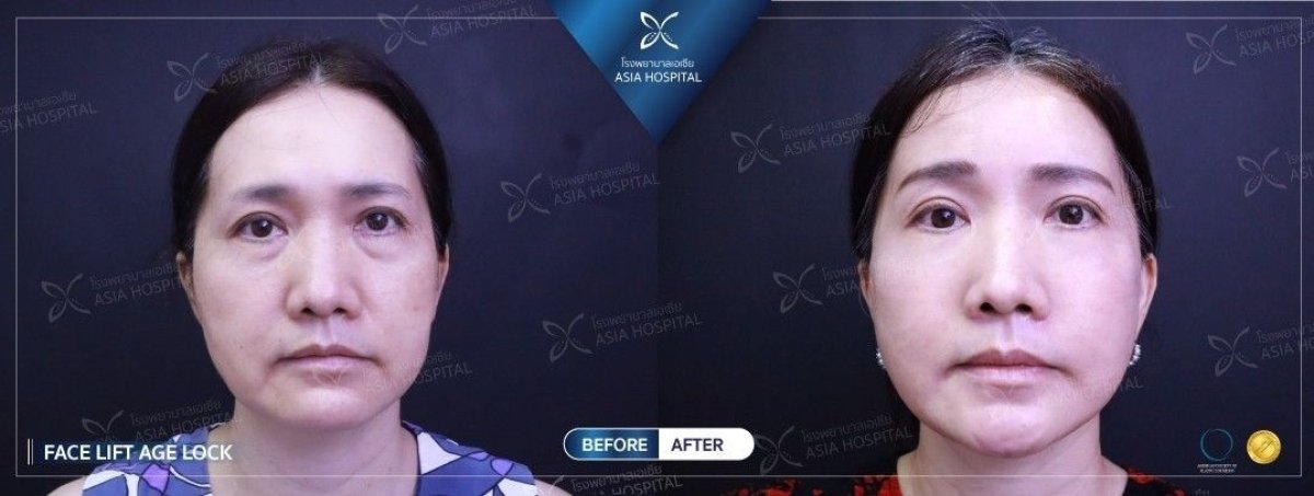 نتائج شد الوجه المصغر قبل وبعد في Asia Cosmetic Hospital، تجديد شباب الوجه