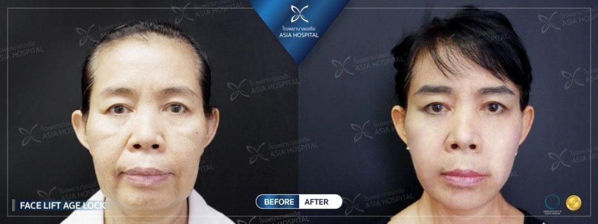 Mini facelift before and after results at Asia Cosmetic Hospital, visible facial rejuvenation