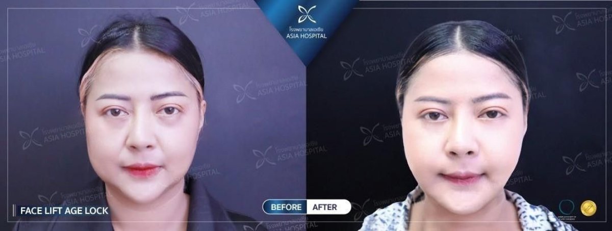 Before and after mini facelift results at Asia Cosmetic Hospital, visible facial rejuvenation