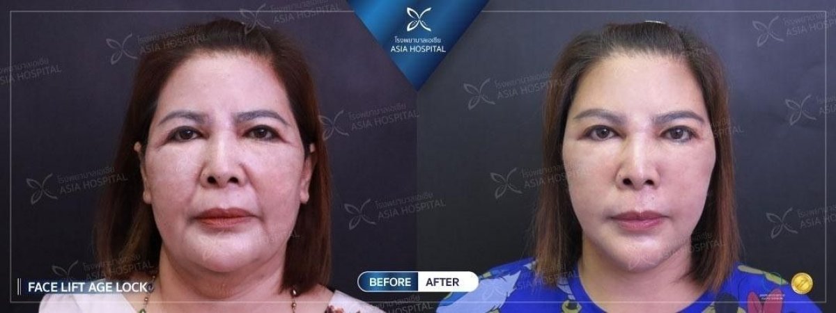 Before and after mini facelift results at Asia Cosmetic Hospital, visible facial rejuvenation