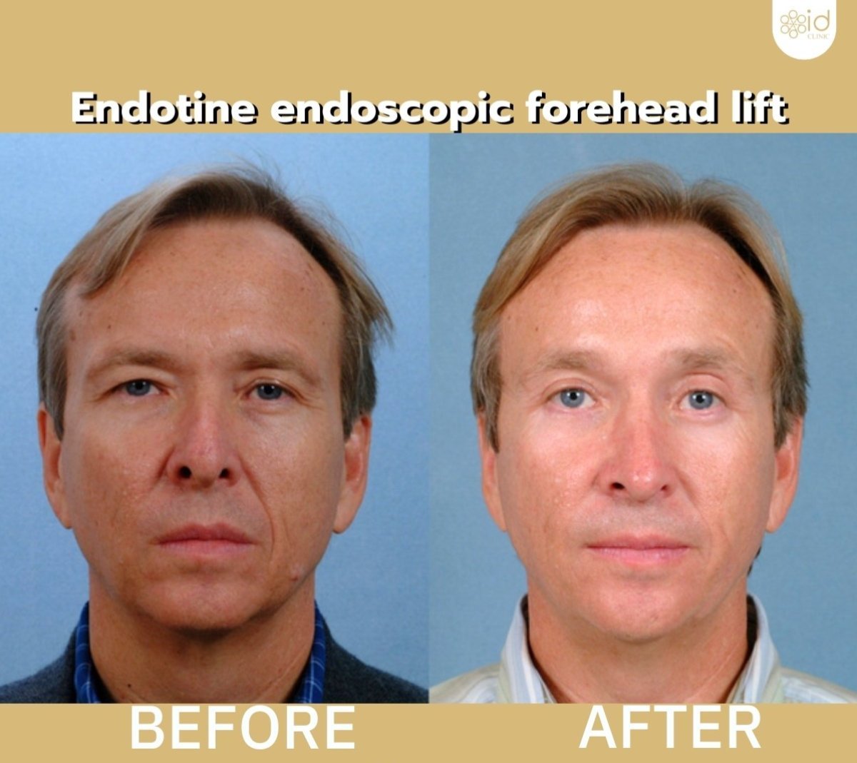 Before and after brow lift results at ID Clinic Bangkok, endoscopic forehead lift improvement