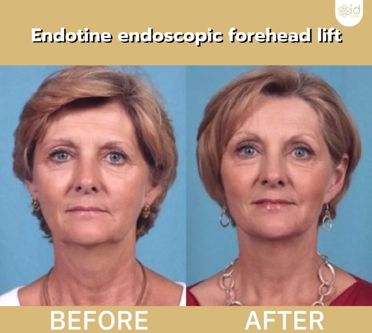 Before and after brow lift results at ID Clinic Bangkok – forehead rejuvenation procedure