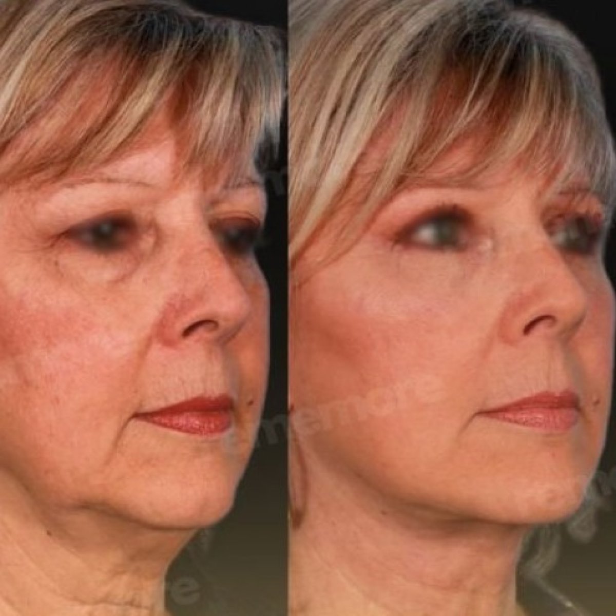 Facelift before and after results at Memorial Şişli Hospital – visible facial rejuvenation