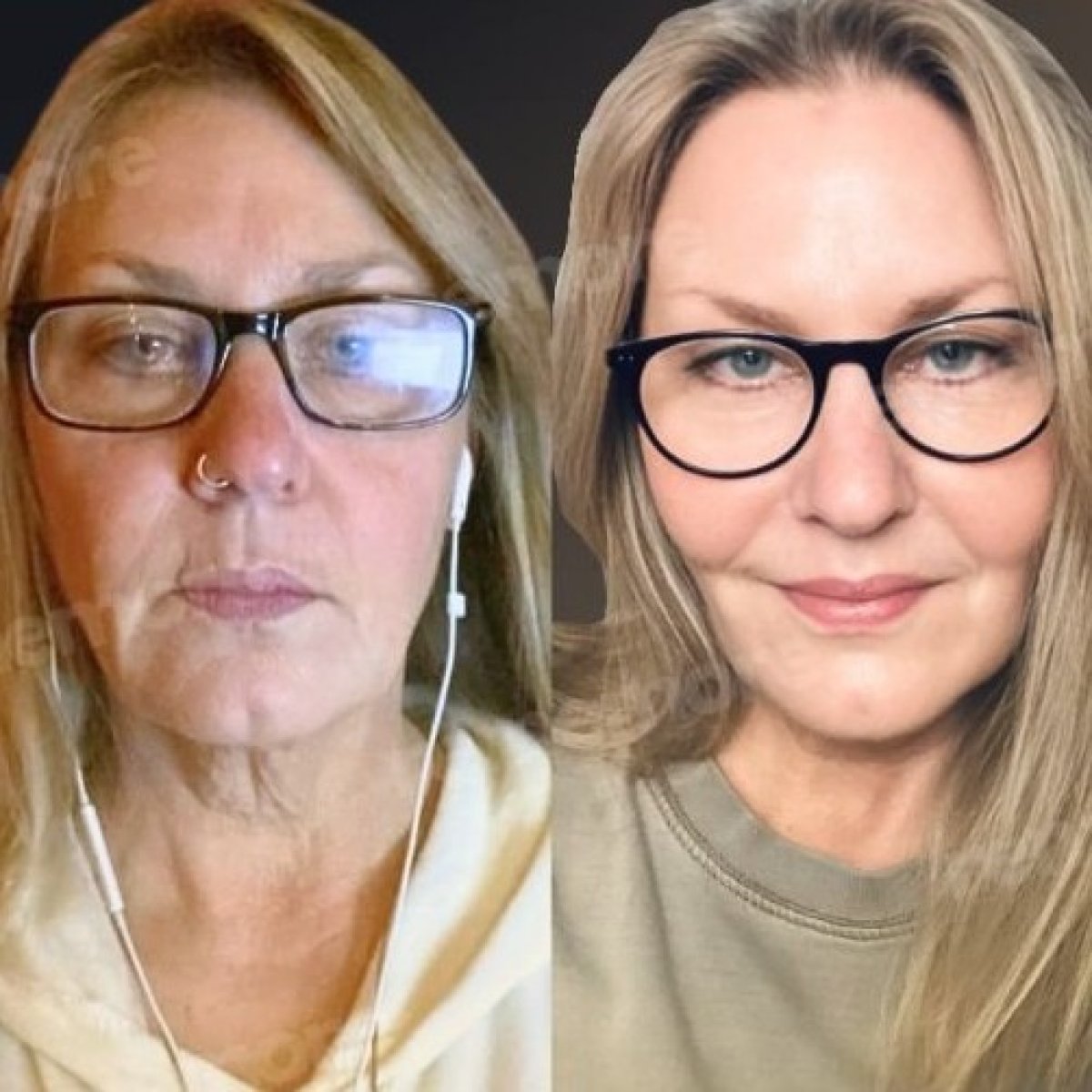 Facelift before and after results at Memorial Şişli Hospital, visible facial rejuvenation