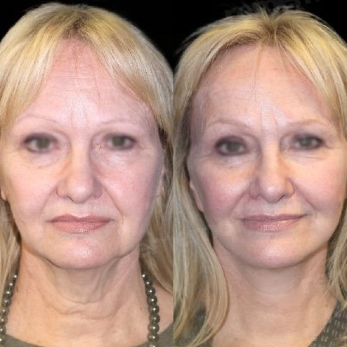 Facelift before and after results at Memorial Şişli Hospital, visible facial rejuvenation