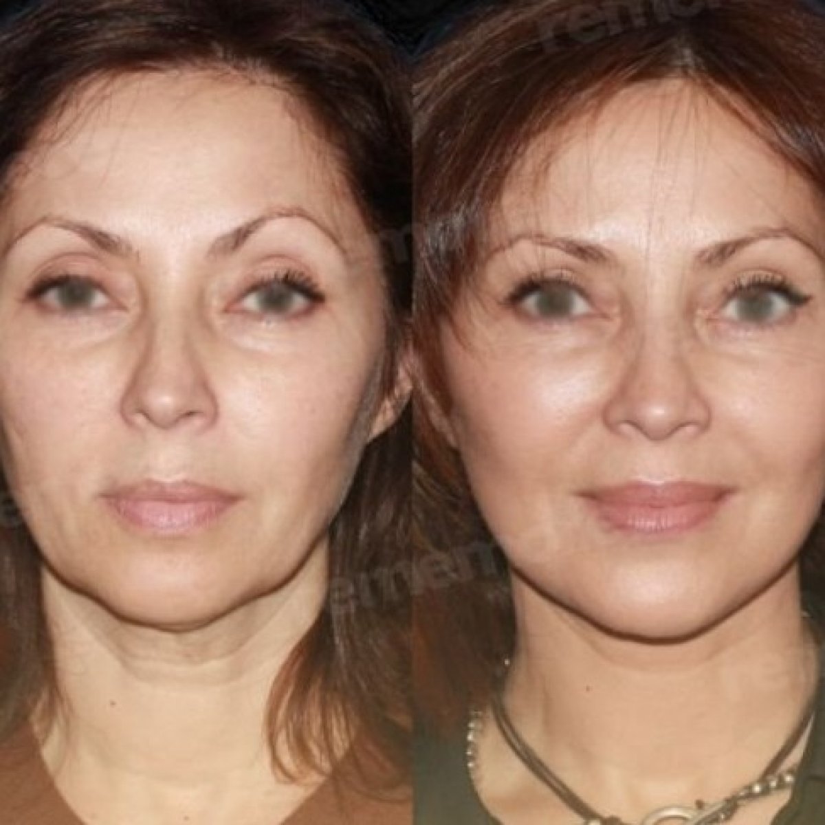 Facelift before and after results at Memorial Şişli Hospital, visible facial rejuvenation