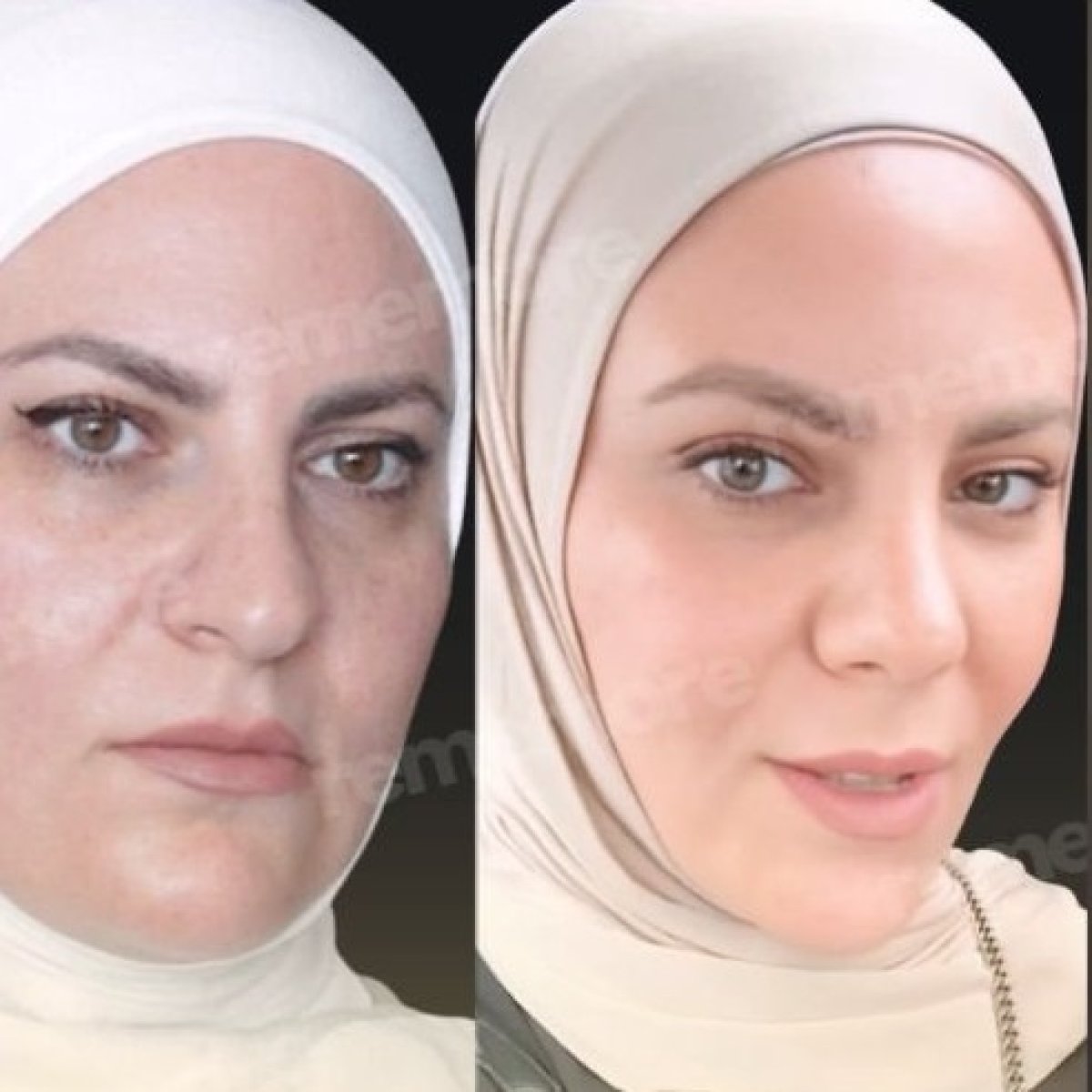 Facelift before and after results at Memorial Şişli Hospital, visible facial rejuvenation
