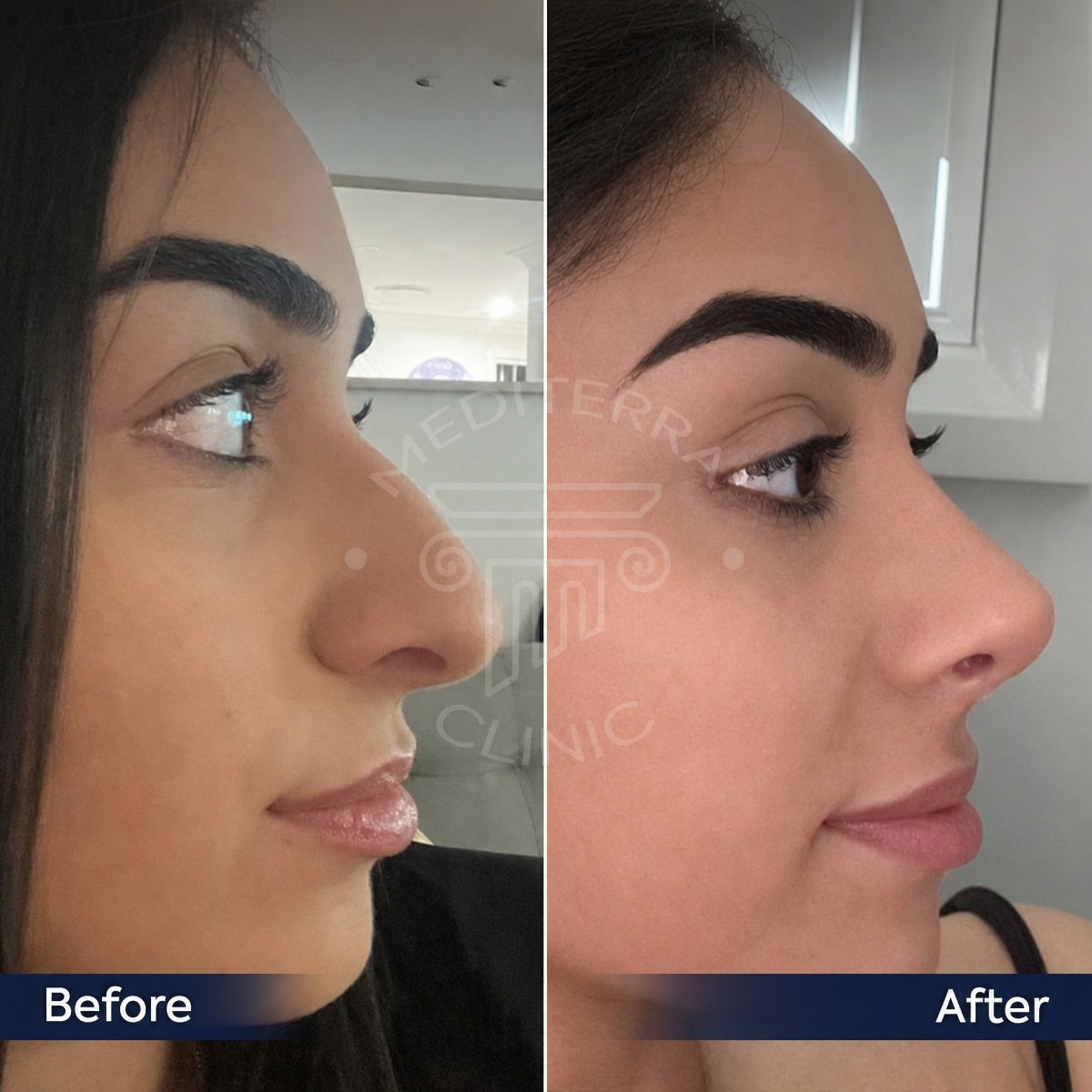 Resultados antes y después de rinoplastia abierta en Dr. Safa Manav Clinic, remodelación nasal