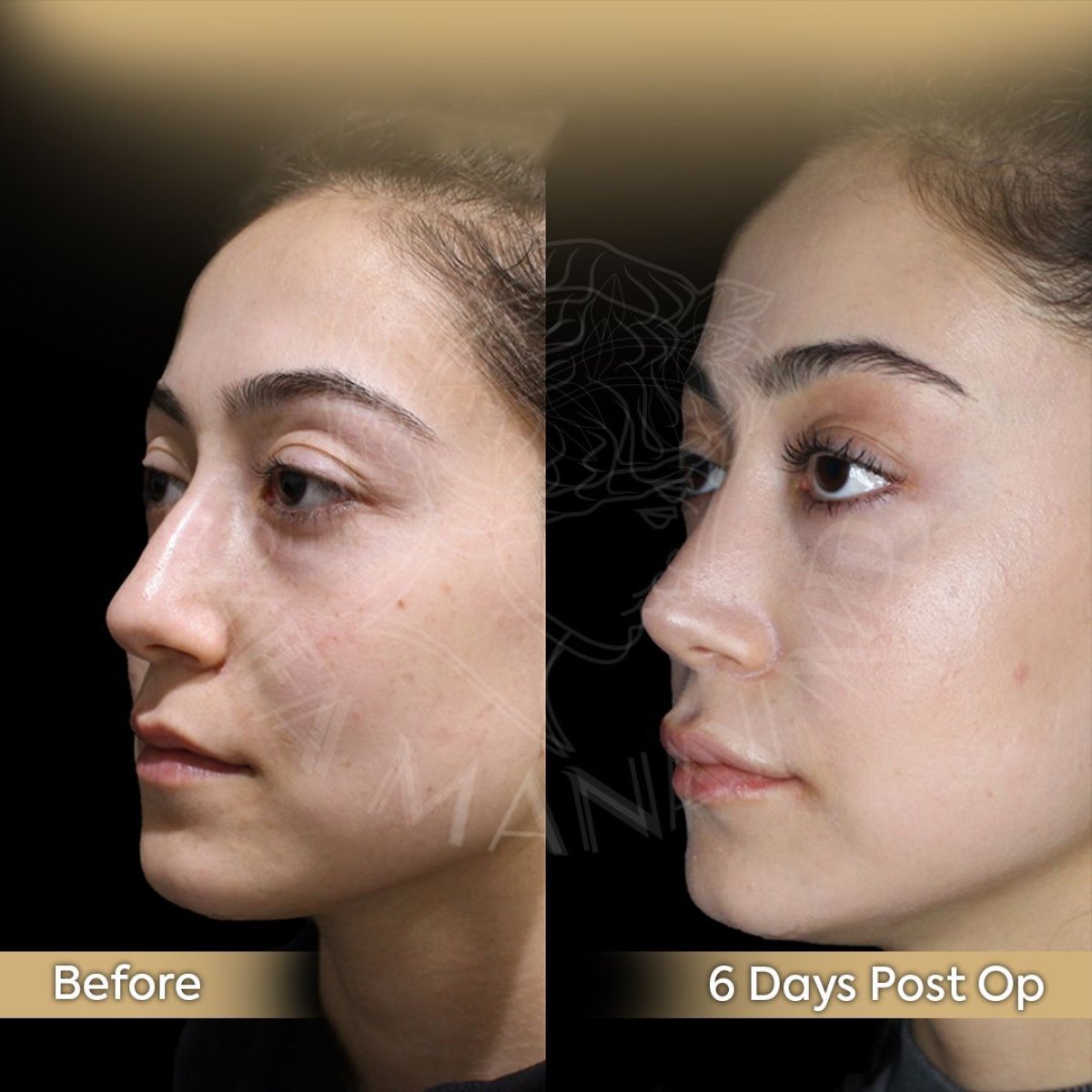 Resultados antes y después de rinoplastia abierta en Dr. Safa Manav Clinic, remodelación nasal visible
