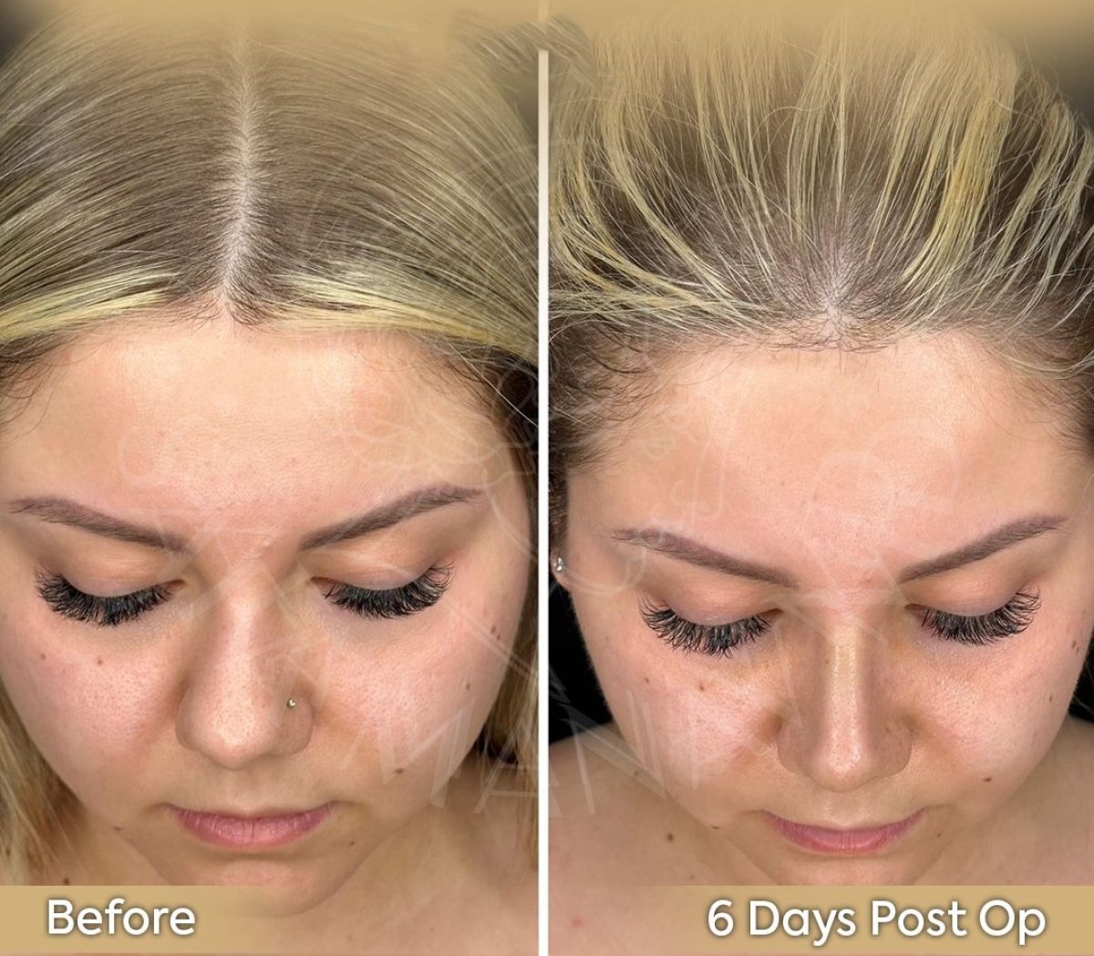 Resultados de rinoplastia abierta en Dr. Safa Manav Clinic, recuperación a los 6 días