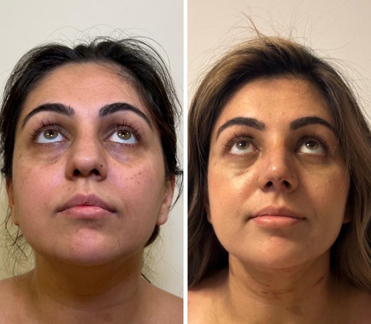 نتائج قبل وبعد عملية تجميل الأنف المفتوحة في عيادة Dr. Safa Manav، تحسين شكل الأنف
