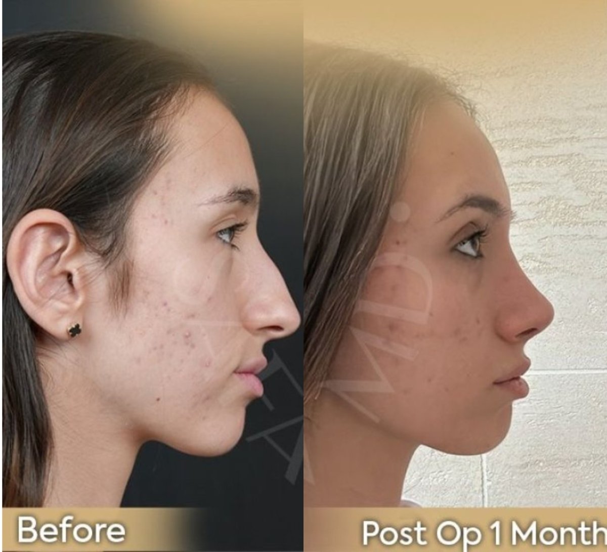 نتائج قبل وبعد عملية تجميل الأنف المفتوحة في عيادة Dr. Safa Manav، تحسين شكل الأنف