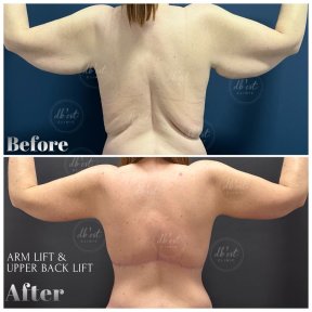 All Included Breast Uplift with Double Board Certified Surgeon