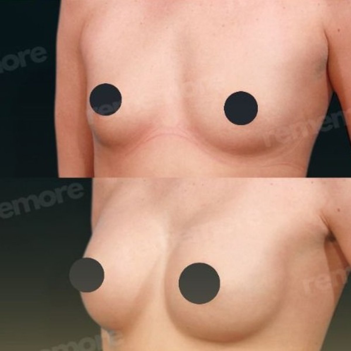 Before and after breast augmentation results at Memorial Antalya Hospital, enhanced breast shape