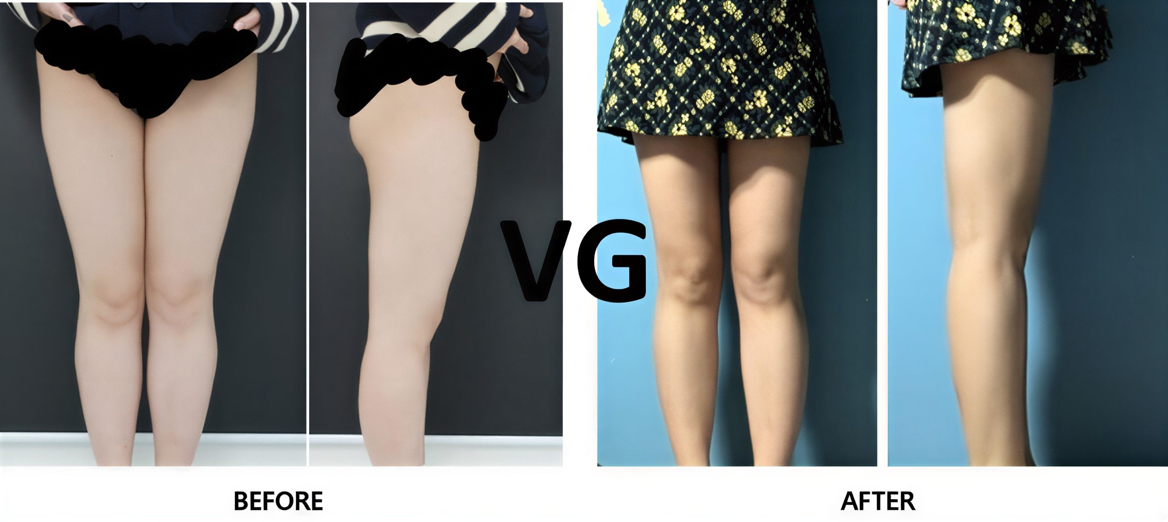 نتائج شد الفخذين قبل وبعد في VG Plastic Surgery، تحسين شكل الساقين وتناسقهما