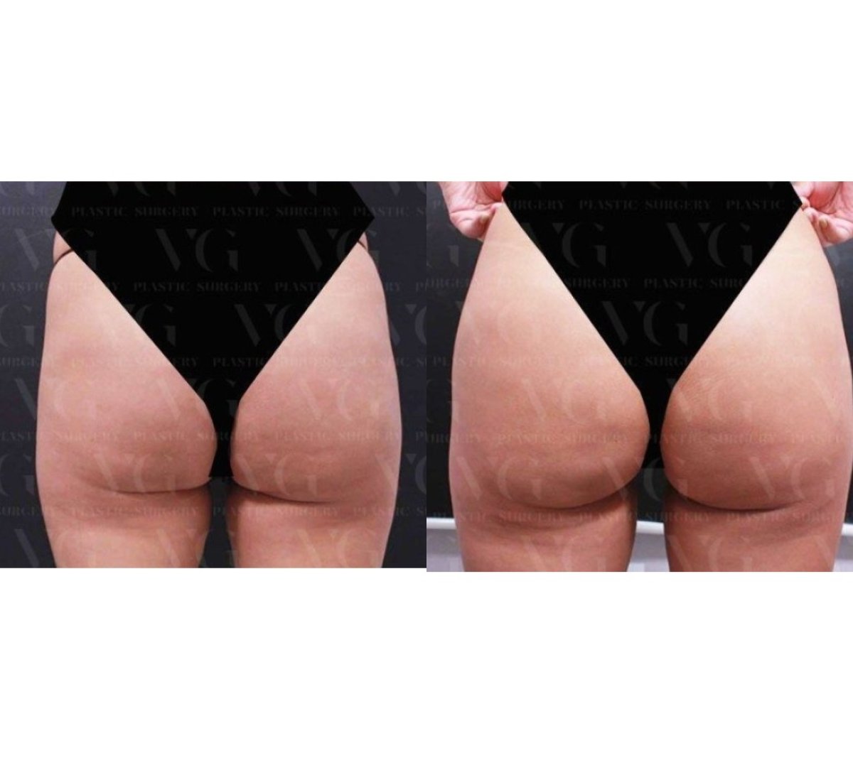 نتائج شد الفخذين قبل وبعد في VG Plastic Surgery، تحسين شكل وتماسك الفخذين