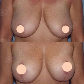 Premium Breast reduction w& Lift All Included (No Implants) - photo 3