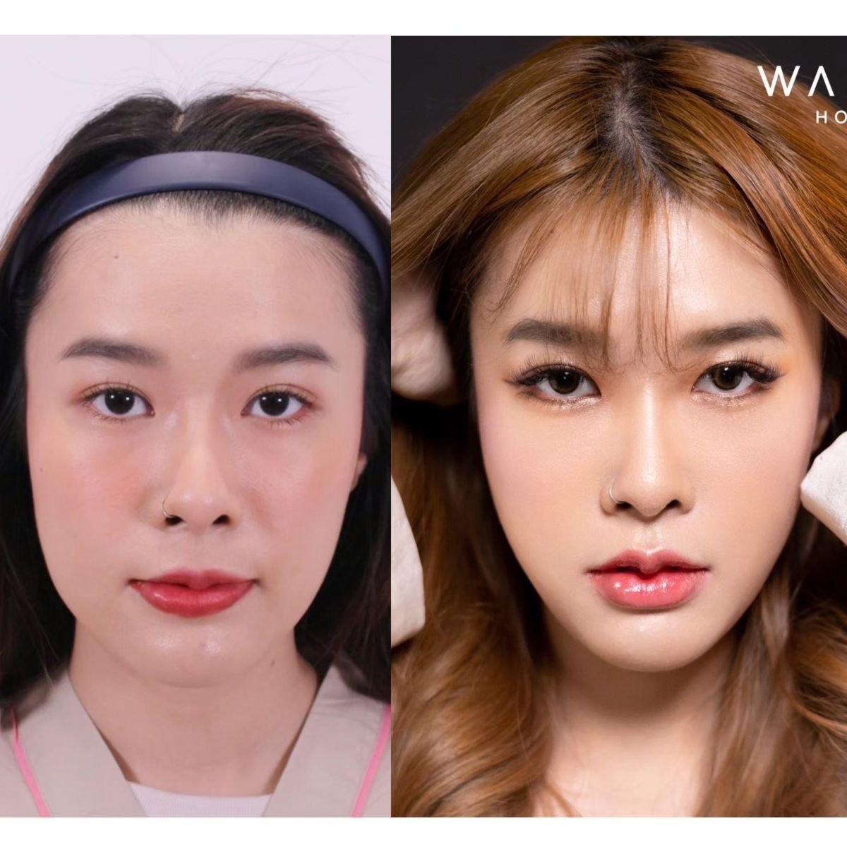 Antes y después de reducción de pómulos en Wansiri Hospital, resultados de contorno facial