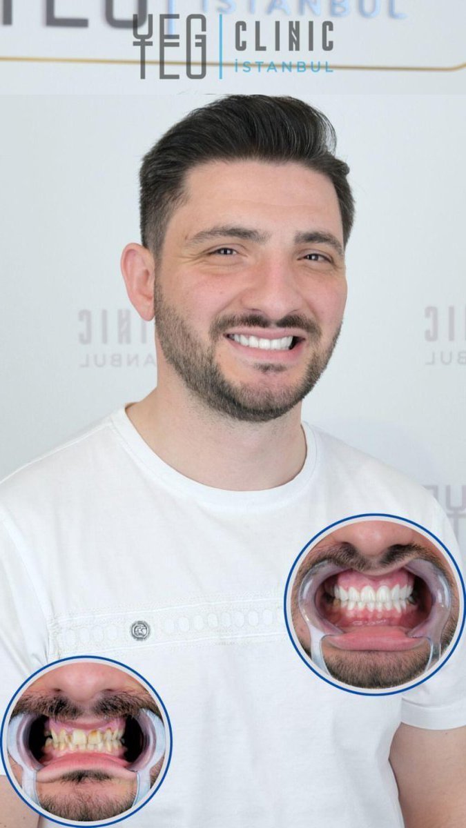 Resultados de bonding dental antes y después en YEG Clinic – sonrisa mejorada y dientes blancos