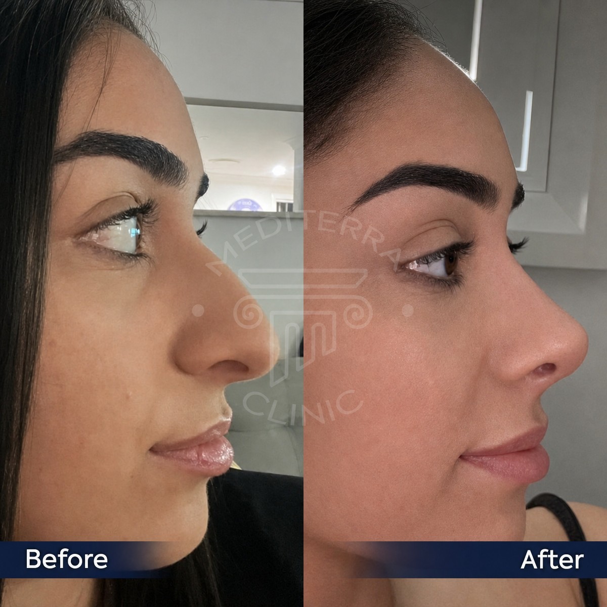 نتائج عملية تجميل الأنف قبل وبعد في عيادة Dr. Safa Manav، تحسين شكل الأنف