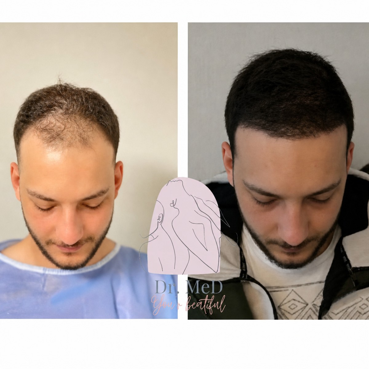 Before and after FUE hair transplant result at Dr. MED – restored hairline and fuller hair