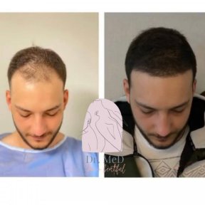 FUE hair transplant All Included - photo 2