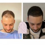 صور قبل وبعد زراعة الشعر للدكتور Hakan Ikizoglu