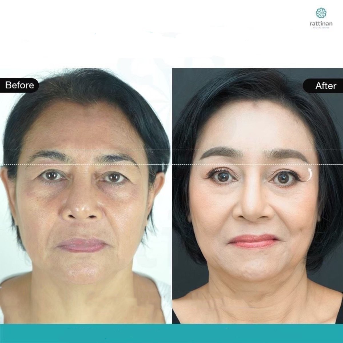 Resultados de lifting de cejas antes y después en Rattinan Clinic, rejuvenecimiento visible