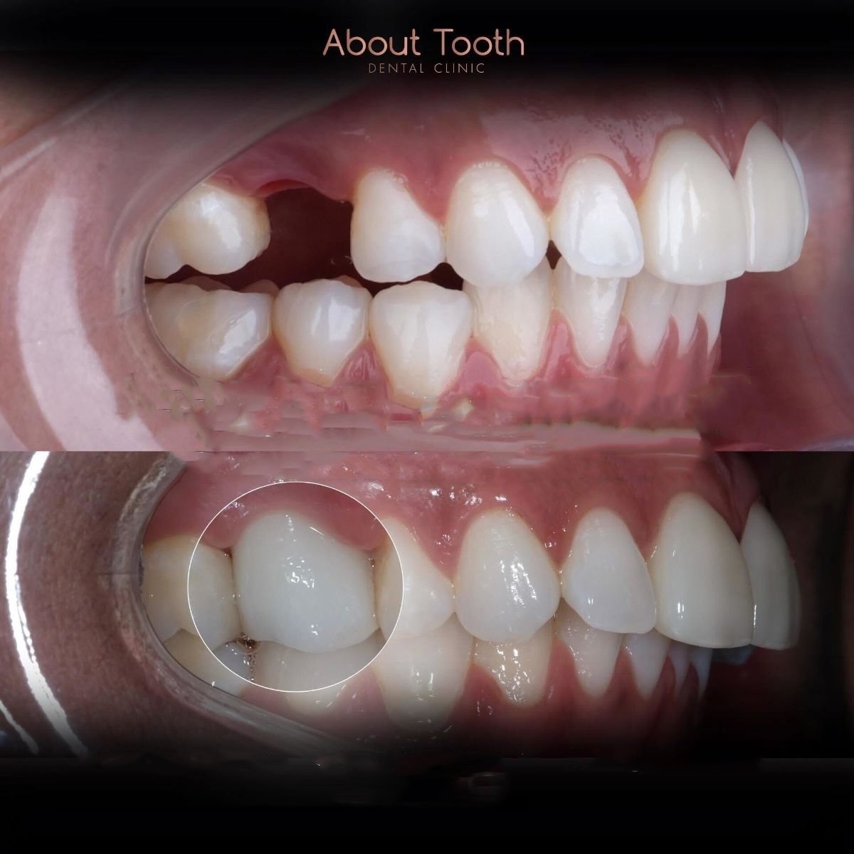 Before and after dental implant results at About Tooth Dental Clinic, restored missing tooth