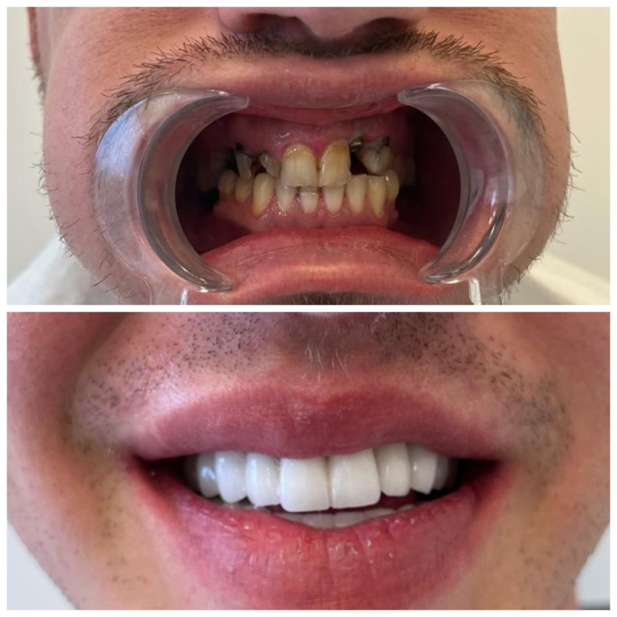 Efekty przed i po implantacji zęba z koroną w My Nova Kusadasi Dental Clinic