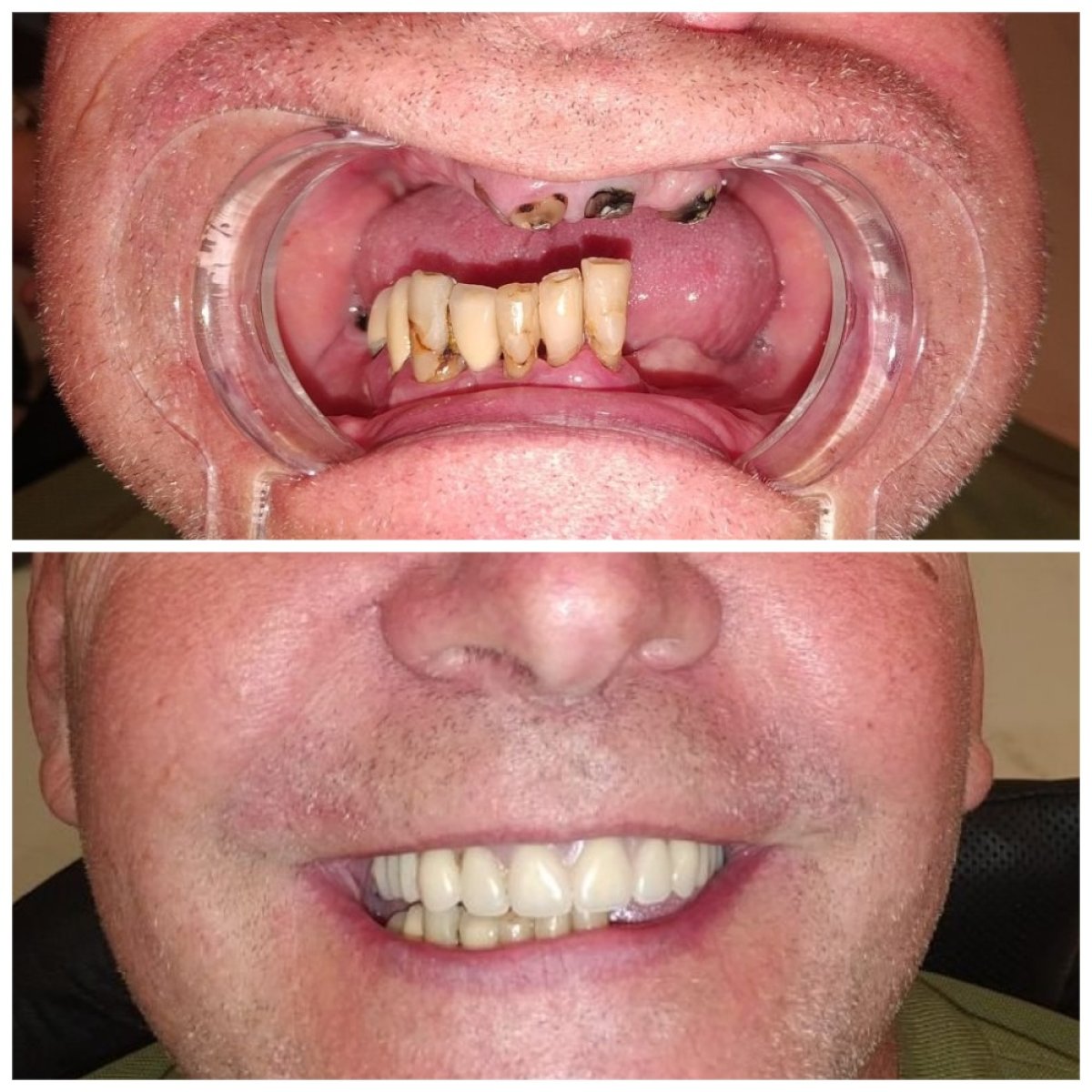Resultados antes y después de implante dental con corona en My Nova Kusadasi Dental Clinic