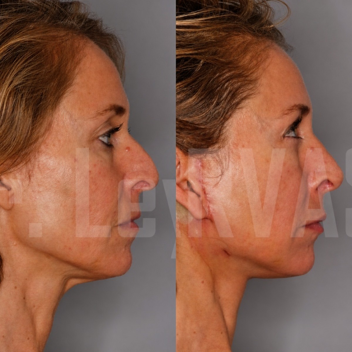 Before and after neck lift results at Quartz Hospital, visible neck contour improvement