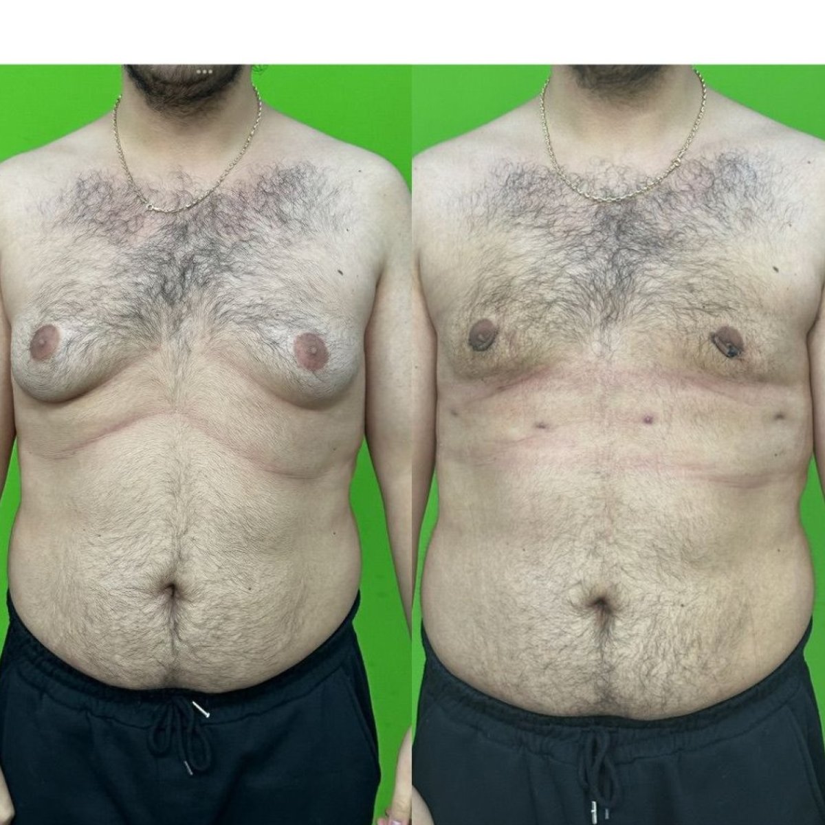 Before and after gynecomastia surgery results at Prof. Furkan Karabekmez's Aesthetic Clinic