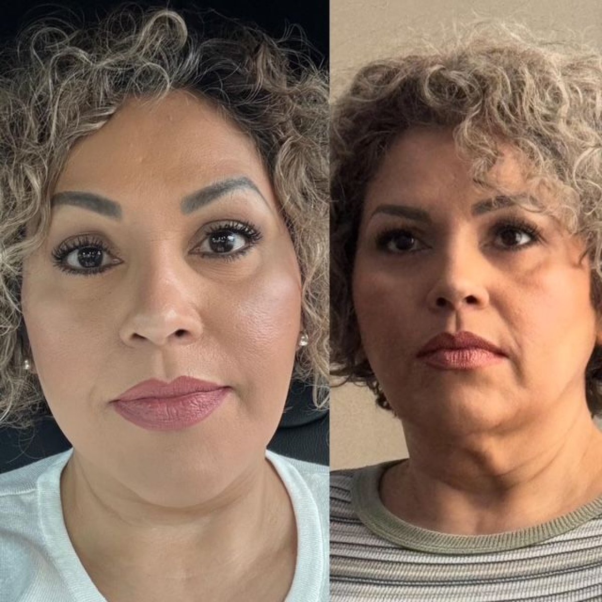 نتائج شد الوجه قبل وبعد في عيادة Marroquín & Sandoval لجراحة التجميل، تجديد شباب الوجه