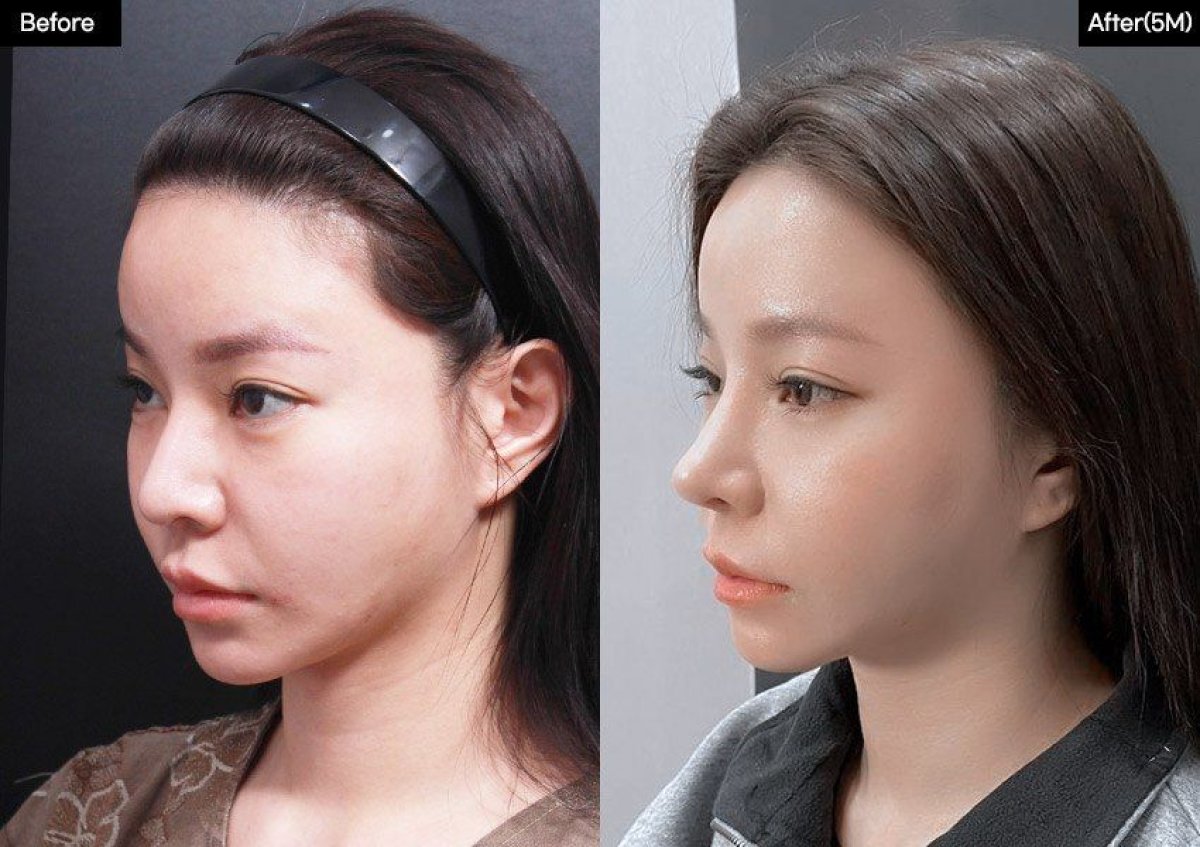 نتائج قبل وبعد عملية تجميل الأنف المغلقة في VG Plastic Surgery، تحسين شكل الأنف