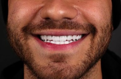 E-Max Veneer - Hollywood Smile - photo 3