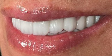 E-Max Veneer - Hollywood Smile - photo 5