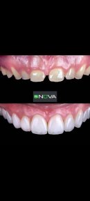 All-on-4 Dental Implants ıncluding Crows + Accomodation+Transfer - photo 5