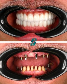 All-on-4 Dental Implants "MEGAGEN" For 1 Jaw - photo 4
