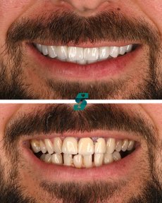 All-on-4 Dental Implants "MEGAGEN" For 1 Jaw - photo 3