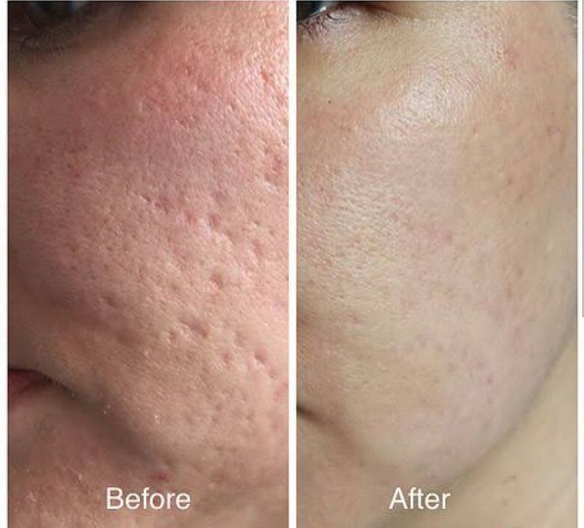 Laser skin resurfacing before and after results at ID Clinic Bangkok, smoother facial skin