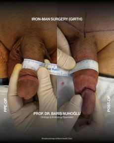 Premium Penis enlargement All Included - photo 3