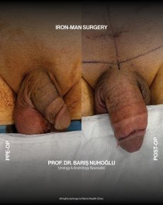 Premium Penis enlargement All Included - photo 4