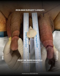 Premium Penis enlargement All Included
