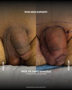 Premium Penis enlargement All Included - photo 3