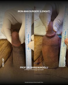 Premium Penis enlargement All Included - photo 5