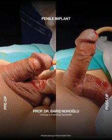 Premium Penile implant surgery All Included