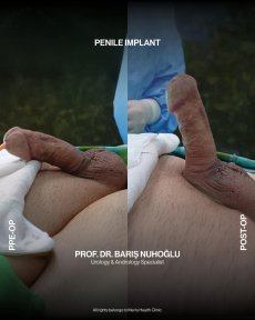 Premium Penile implant surgery All Included - photo 3